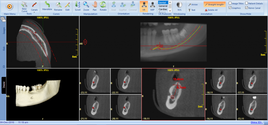 CBCT Scan on PACS Viewer