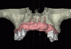 CT Dent simplant1-300x207 simplant1  