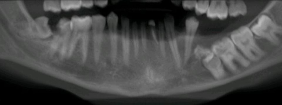 CT Dent Capture-1-960x358 Case of the Month - Impacted Teeth  