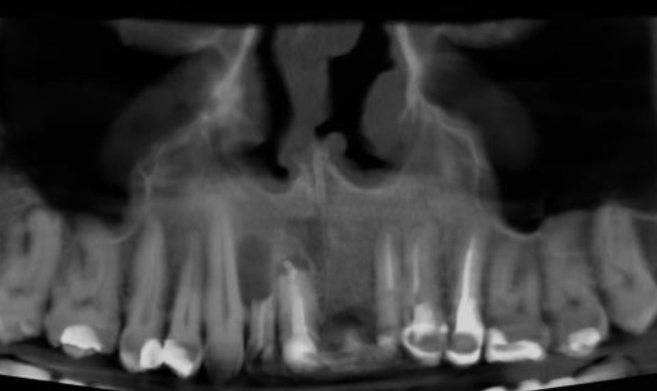CT Dent Capture-1-960x571 Case of the Month - Periapical Lesions  