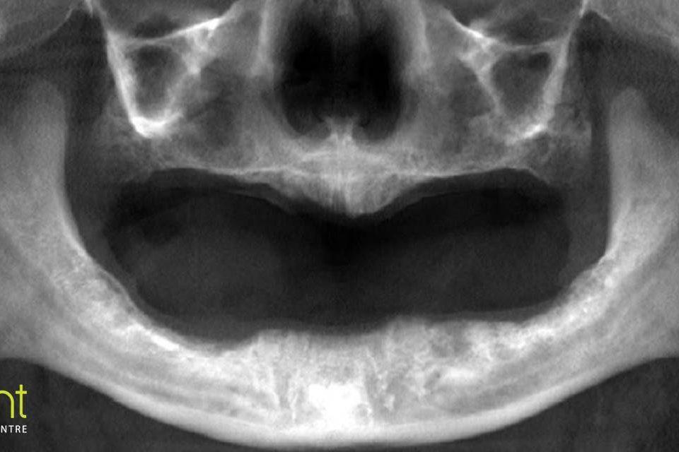CT Dent Jan19-1-960x640 Case of the Month - Planning for Dental Implants  