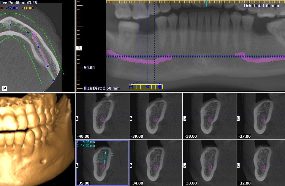 CT Dent CBCT-Implant-image-from-Zahra-960x627 Dental CT Scan Justification: Ensuring Patient Safety and Effective Diagnosis  