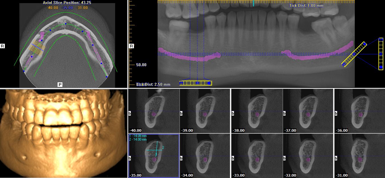 CBCT Implant image from Zahra