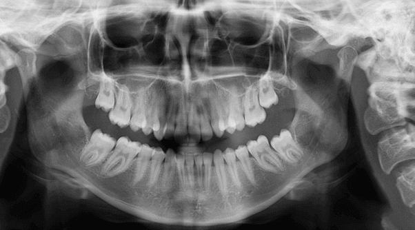 Opg X Ray Ct Dent