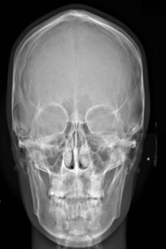 PA Digital Cephalometric