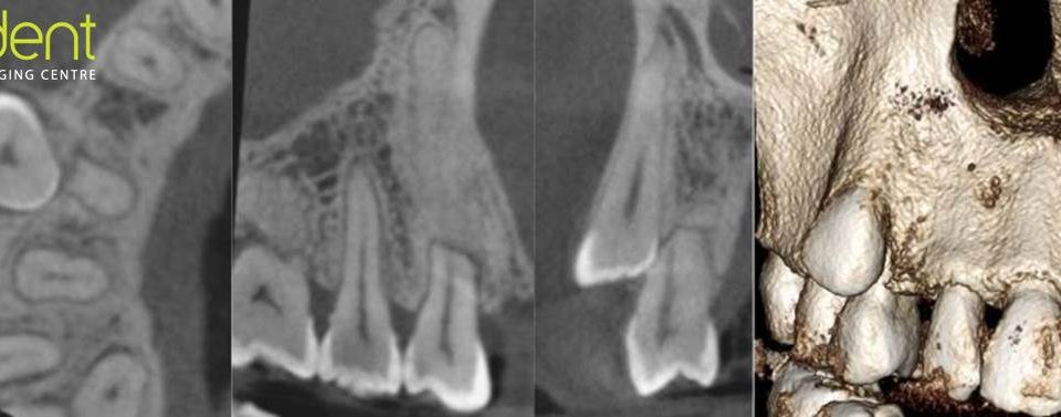 CT Dent COMMay191-960x377 Case of the month - Diagnosis of a Bony Lump  