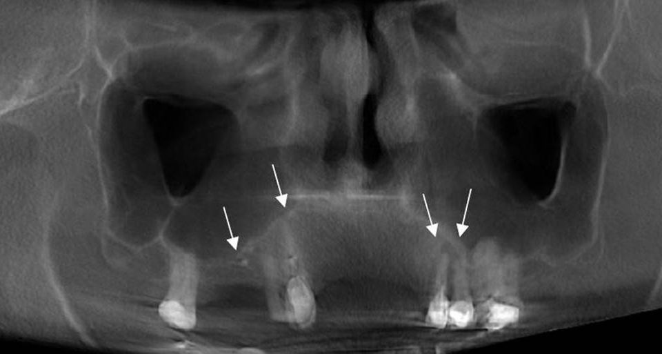 CT Dent 1COMJun19-960x513 Case of the Month - All-on-Four and Zygomatic Implant Planning  