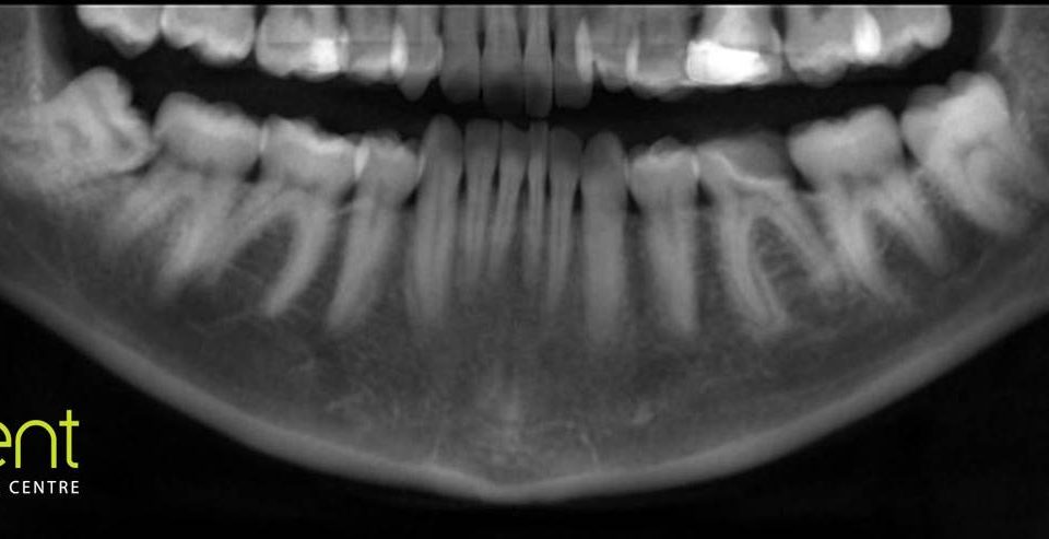 CT Dent Case1-960x493 Case of the Month - The Relationship of the Lower Third Molars with the Mandibular Canal  