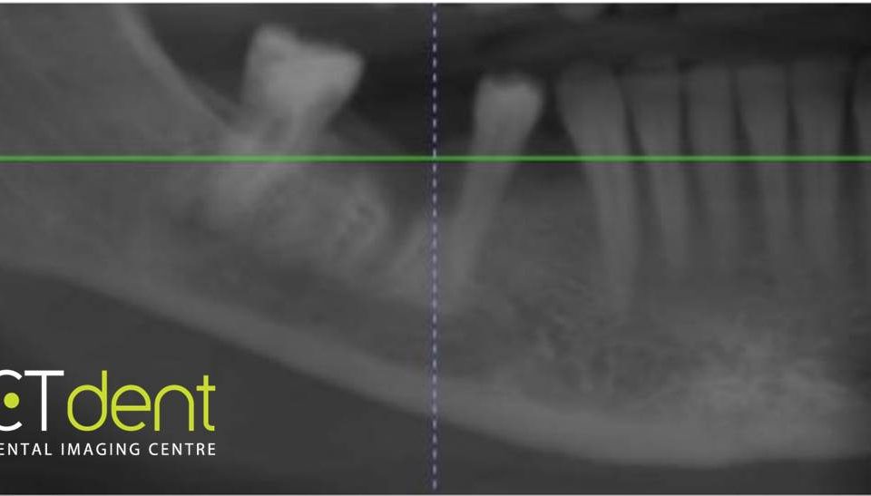 CT Dent COMAug1-960x547 Case of the Month - Implant planning following molar extraction  