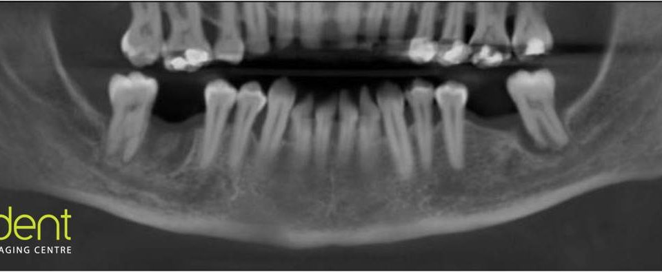 CT Dent COMNov1-960x395 Case of the month - Implant Planning  