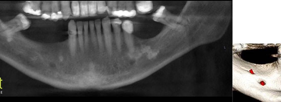 CT Dent COM1Dec19-960x350 Case of the Month - Implant Planning at Multiple Sites in the Mandible  