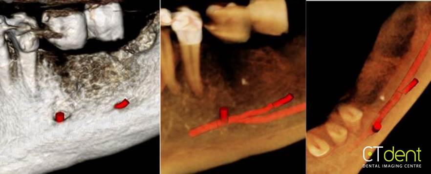 CT Dent COM3Mar2020 Case of the Month - Implant Planning; Accessory Neurovascular Canal  