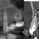 CT Dent 11.20-Pic-2-80x80 Case of the Month - Impacted LL3 with focal osseous dysplasia and compound odontoma  