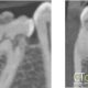 CT Dent Feb2021COM2-80x80 Case of the Month - Implant placement with interesting incidental radiographic findings  