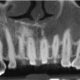 CT Dent Jan2101-80x80 Case of the Month - Invasive Cervical Resorption  