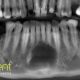 CT Dent COM1-Jun-2021-80x80 Case of the month - Identifying expended lesion  