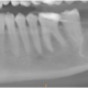 CT Dent With-Logo-1-80x80 Case of the Month - Large cyst anterior mandible  