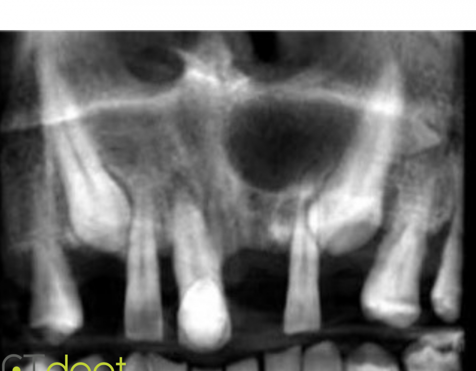 CT Dent 1-1-960x750 Case of the month - Implant analysis requested. Pre-implant UL1  