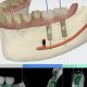 CT Dent DTS_dental_laboratory_glasgow_scotland_uk_digital_scanning_implant_studio-80x80 The Future of Dentistry: Exploring the Benefits of Dental Intra-Oral Scanning  