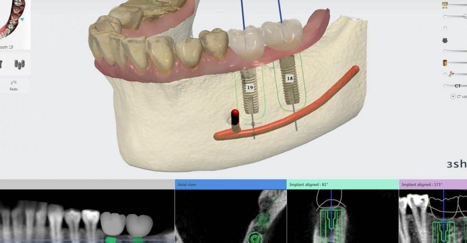 CT Dent DTS_dental_laboratory_glasgow_scotland_uk_digital_scanning_implant_studio-960x500 Enhancing Precision and Efficiency: The Benefits of Guided Surgery in Dentistry   