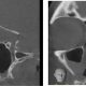 CT Dent Case-Study-1-1024x419-1-80x80 Dental CBCT Scan vs. Dental 2D Imaging: A Comparative Overview  