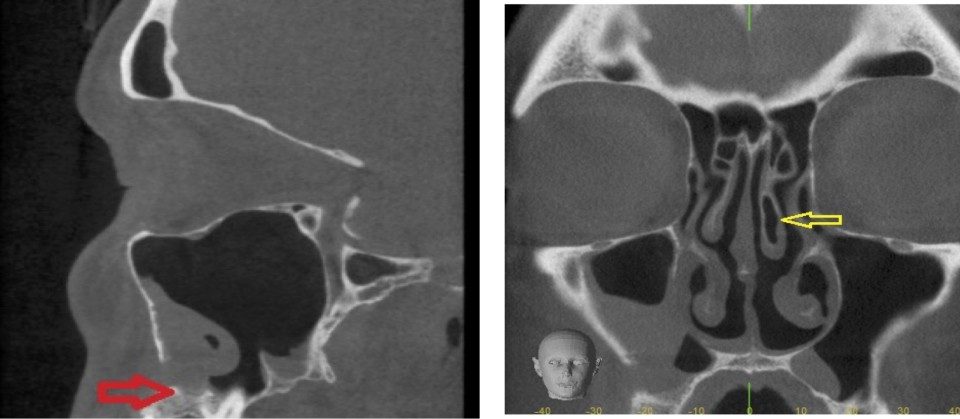 CT Dent Case-Study-1-1024x419-1-960x419 Understanding Dental CBCT and Its Role in Maxillary Sinus Evaluation  