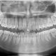 CT Dent DIGITAL-OPG-Orthopantomogram-treatment-pic-80x80 Understanding Dental CBCT and Its Role in Maxillary Sinus Evaluation  