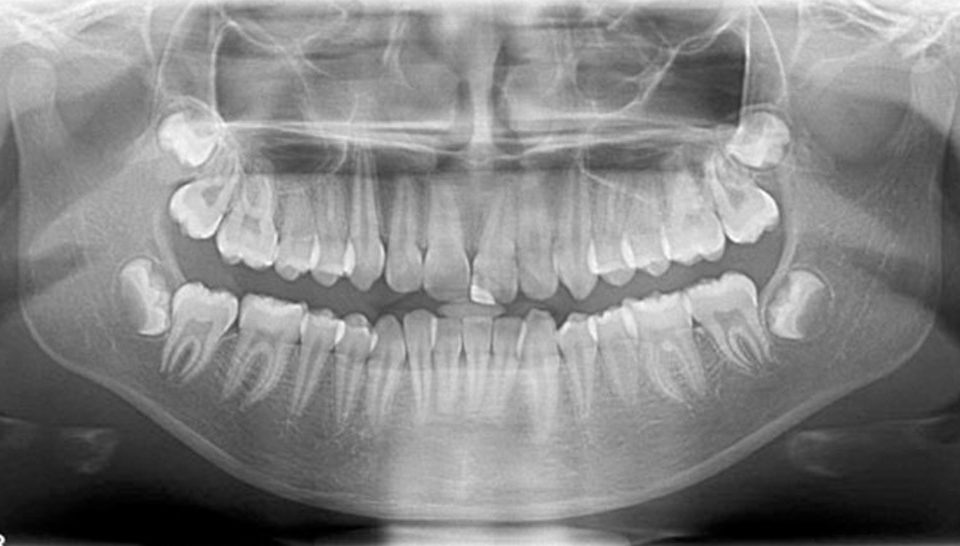 CT Dent DIGITAL-OPG-Orthopantomogram-treatment-pic-960x546 Dental CBCT Scan vs. Dental 2D Imaging: A Comparative Overview  