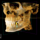 CT Dent cbct-scan-768x564-1-80x80 Understanding Normal Anatomy on Dental CBCT Scans  